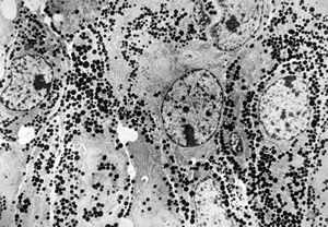F, 41y. | acromegaly - acidophilic pituitary adenoma (STH) F, 41y. | acromegaly - acidophilic pituitary adenoma (STH)